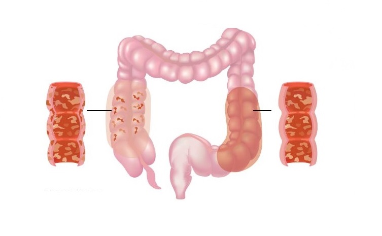 Know more about Mesalamine (Mesacol): uses: Side Effects