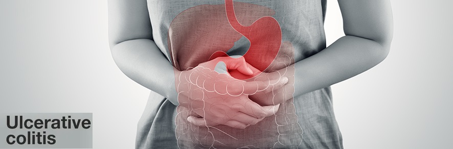 Mesacol: Long Term Use, Side Effects, Warnings & More