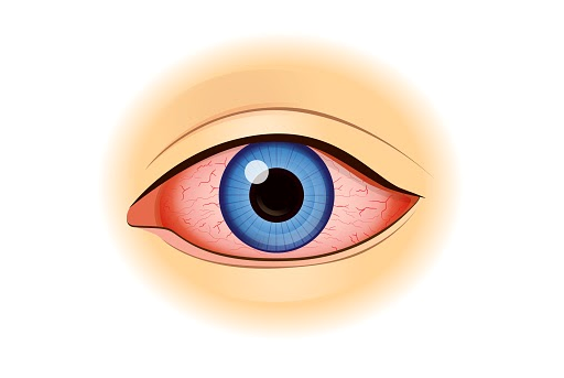 Vigamox Ophthalmic Eye Drops: A solution to bacterial infections